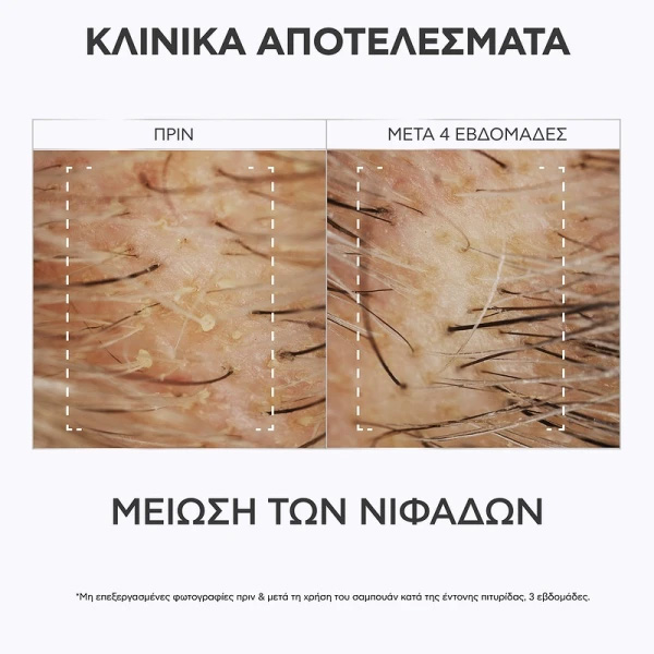 APIVITA - Δερματολογική Λοσιόν Άμεσης Ανακούφισης του Τριχωτού με propolis AmC & Φυτικό AHA - 100ml