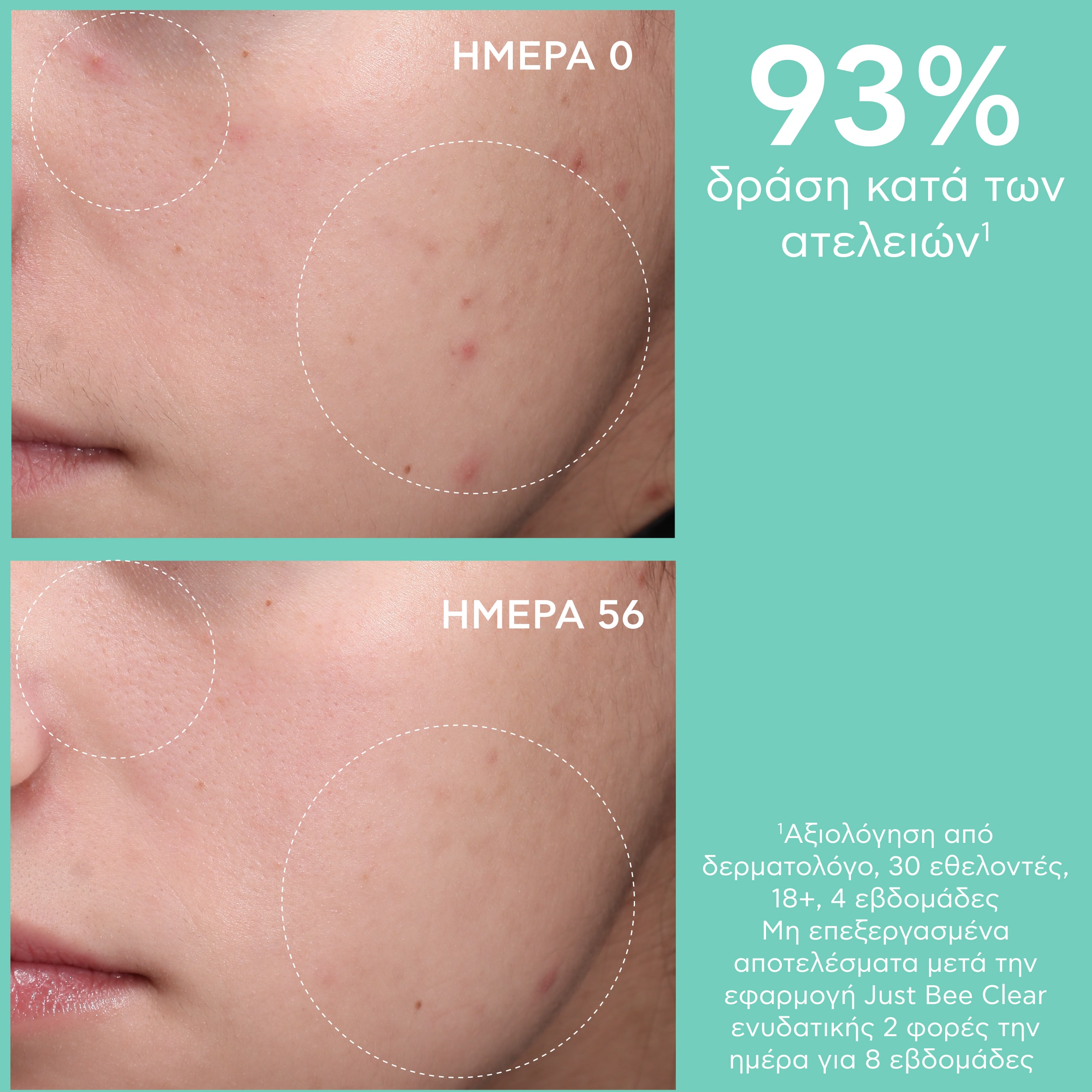 APIVITA - JUST BEE CLEAR Κρέμα Κατά των Ατελειών με propolis AmC & φυτικό σαλικυλικό οξύ - 40ml
